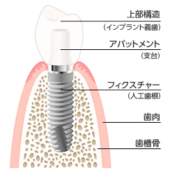 インプラントとは