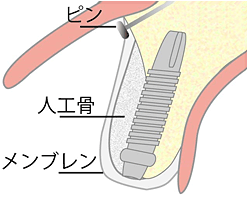 GBR（骨再生誘導法）